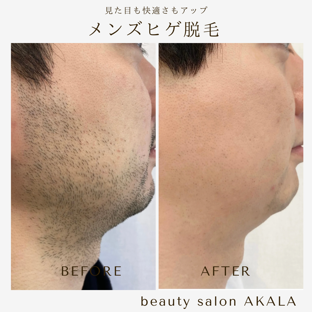 ヒゲ脱毛で男前に